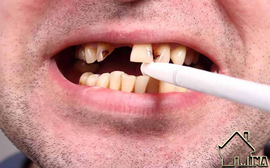 Hút thuốc lá - gây hại cho răng miệng
